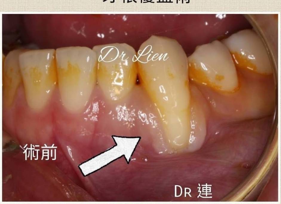 牙根覆蓋術 ft.連淑君醫師