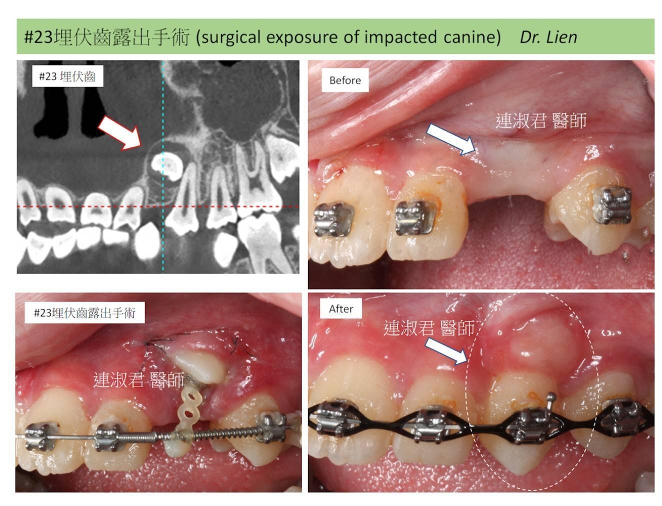 埋伏齒露出手術 ft.連淑君醫師
