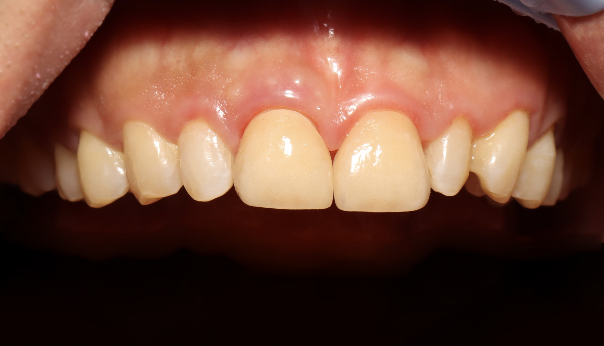 前牙貼片-門牙關縫 ft.郭子睿醫師