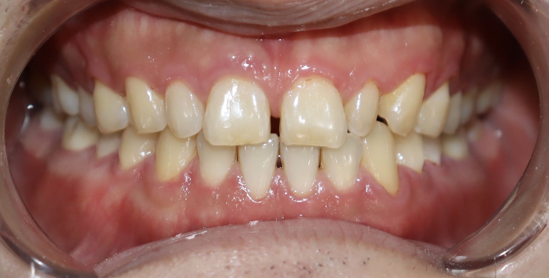 前牙貼片-門牙關縫 ft.郭子睿醫師