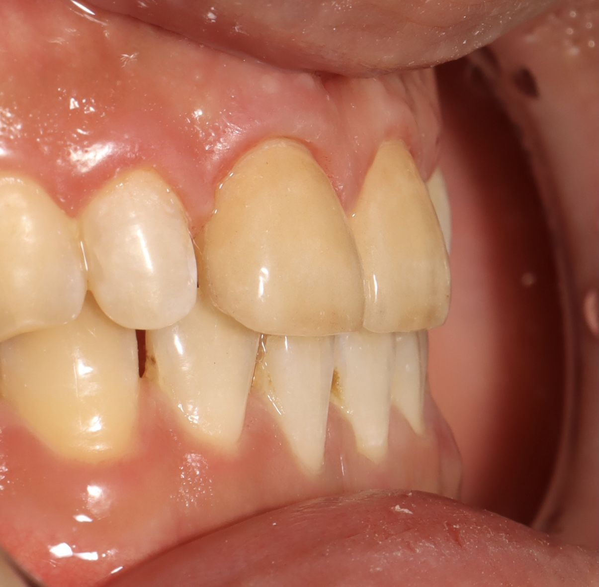 前牙貼片-門牙關縫 ft.郭子睿醫師