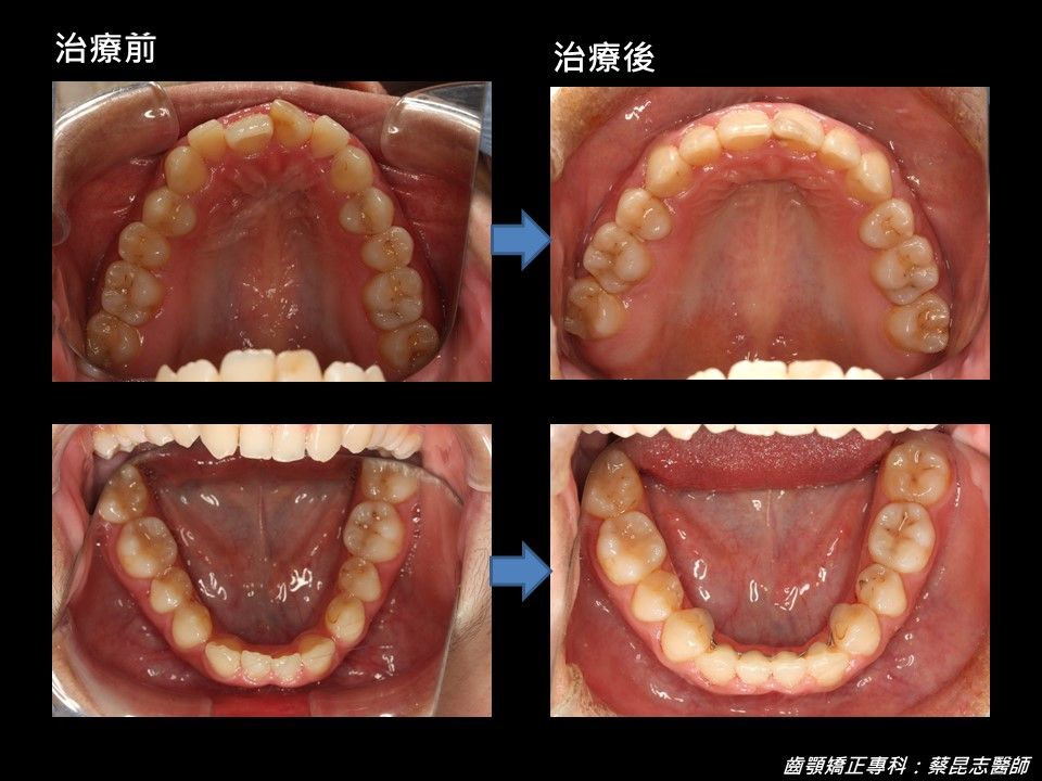 微笑曲線 FT.蔡昆志醫師