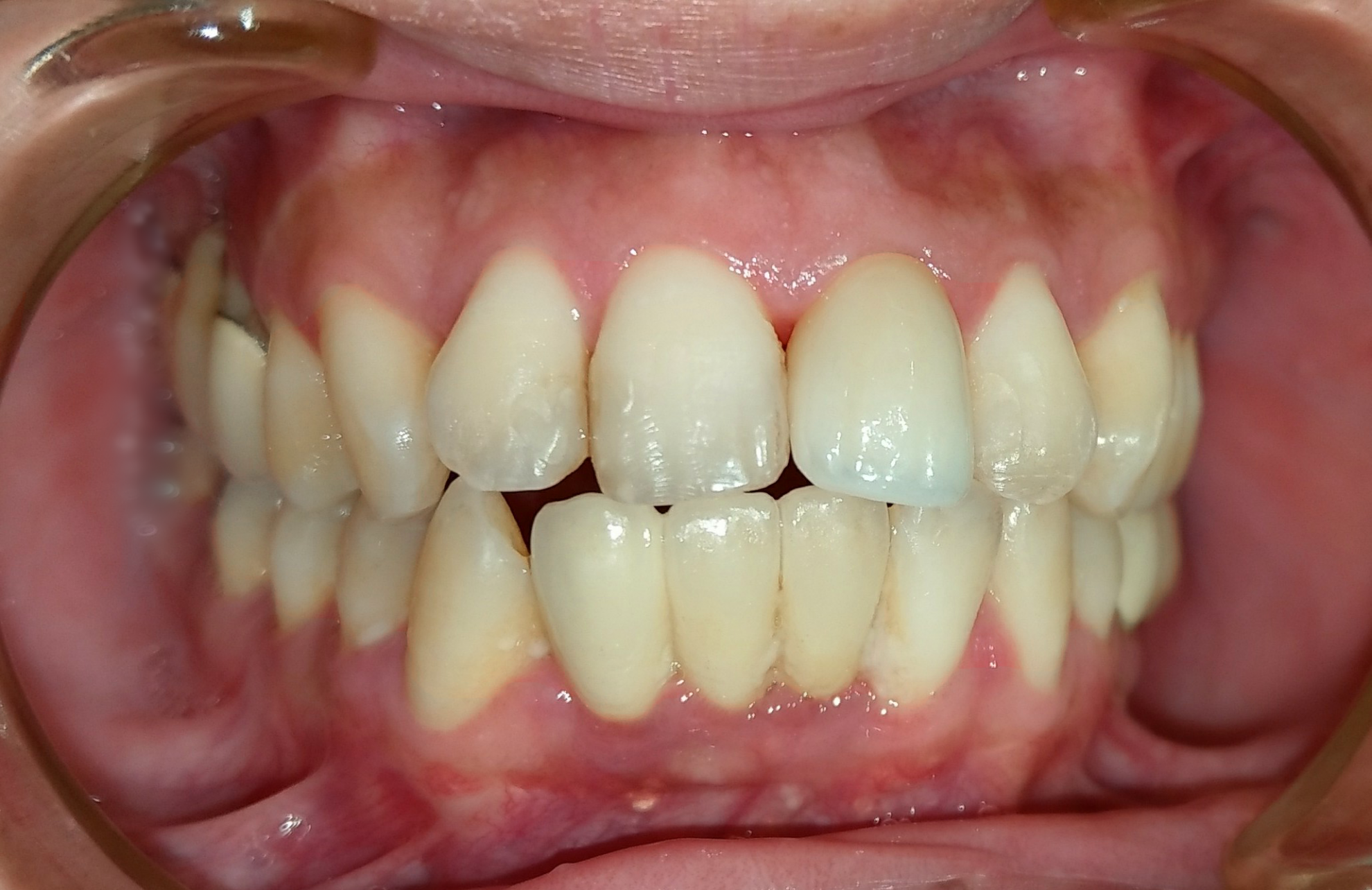 前牙全瓷冠 ft.郭子睿醫師