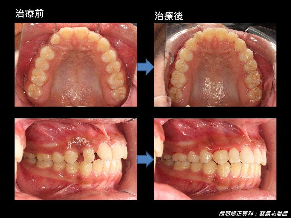 齒顎矯正 FT.蔡昆志醫師