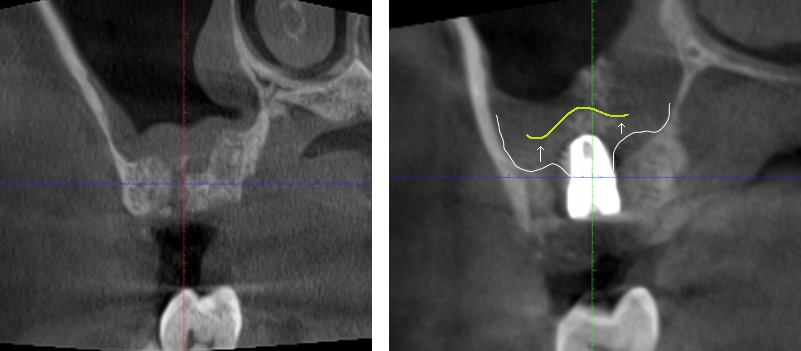 植牙合併上顎竇增高 ft.郭子睿醫師