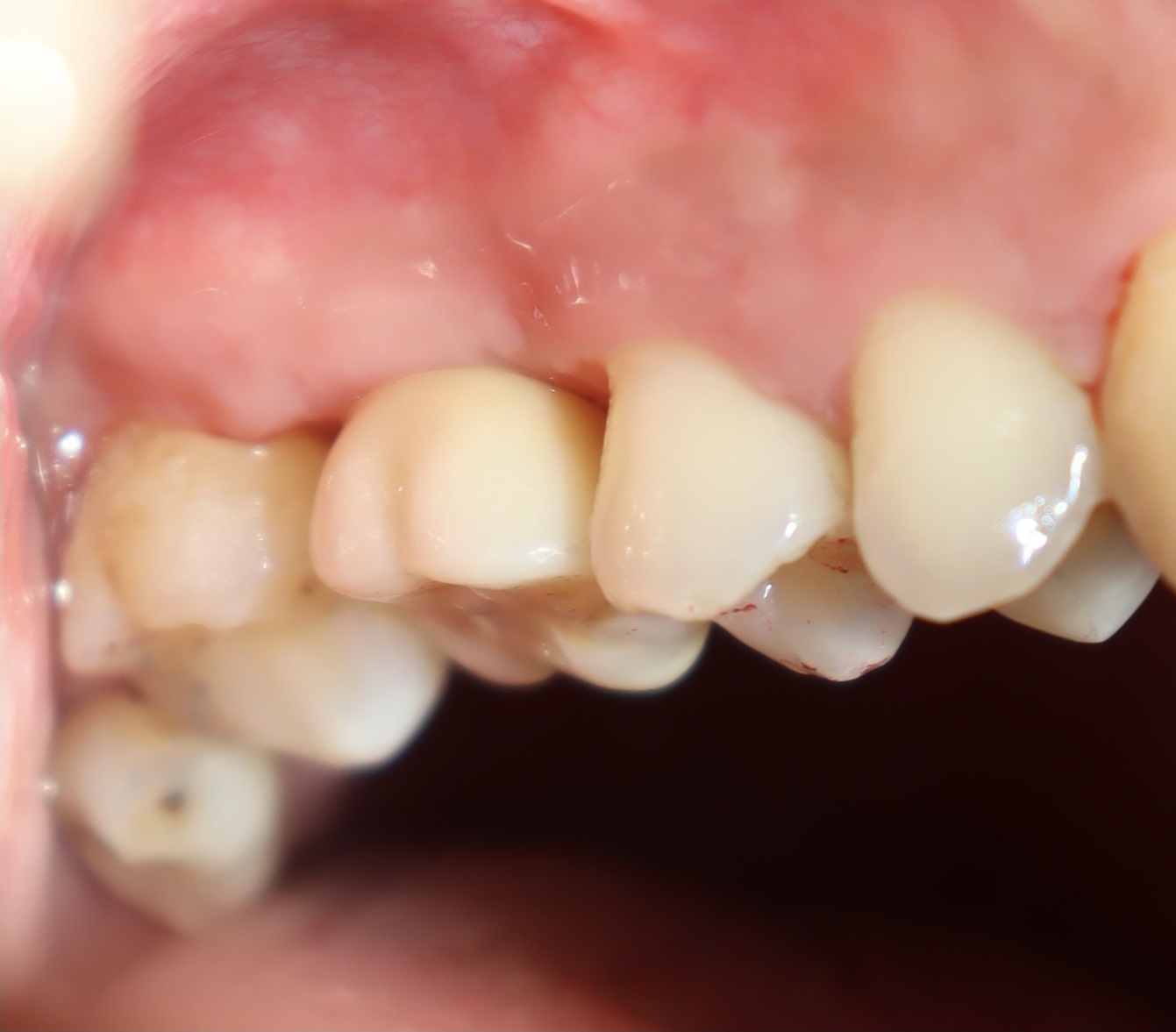 植牙合併上顎竇增高 ft.郭子睿醫師