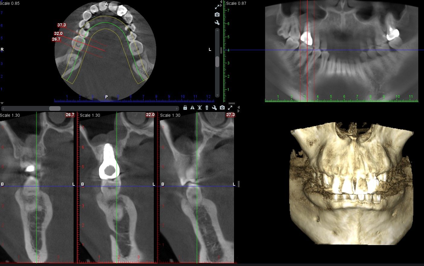 植牙合併上顎竇增高 ft.郭子睿醫師