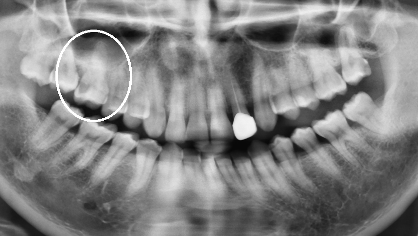 植牙合併上顎竇增高 ft.郭子睿醫師