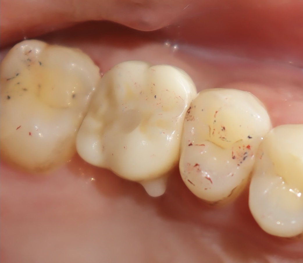 植牙合併上顎竇增高 ft.郭子睿醫師