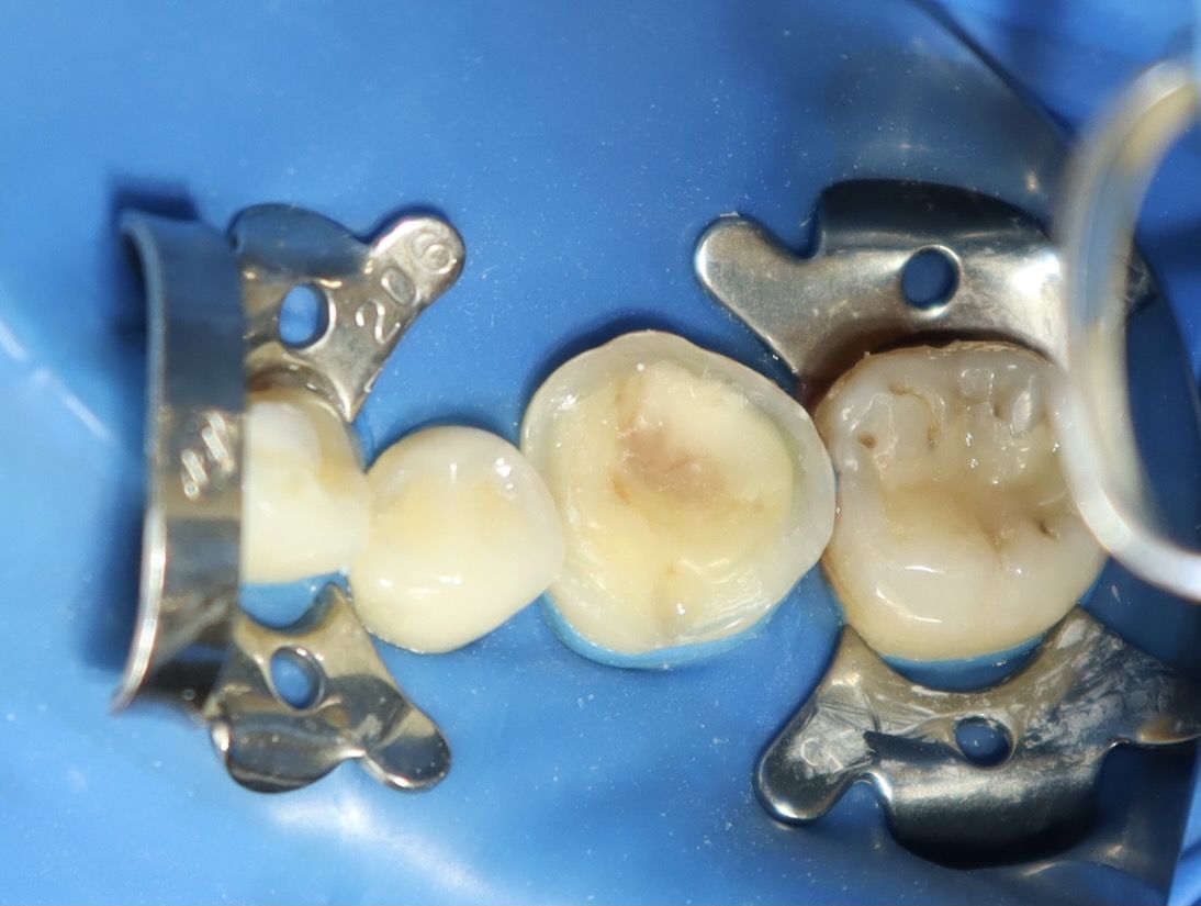 陶瓷嵌體 ft.郭子睿醫師