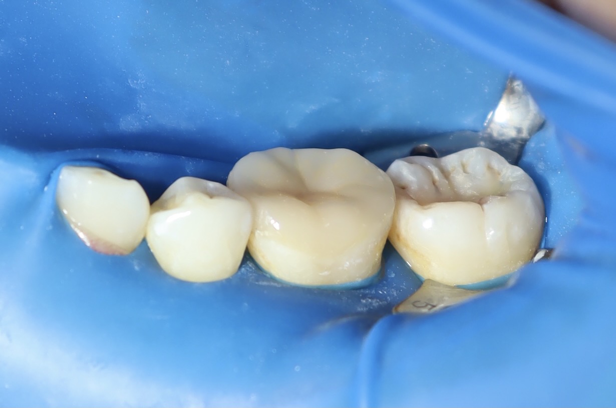 陶瓷嵌體 ft.郭子睿醫師