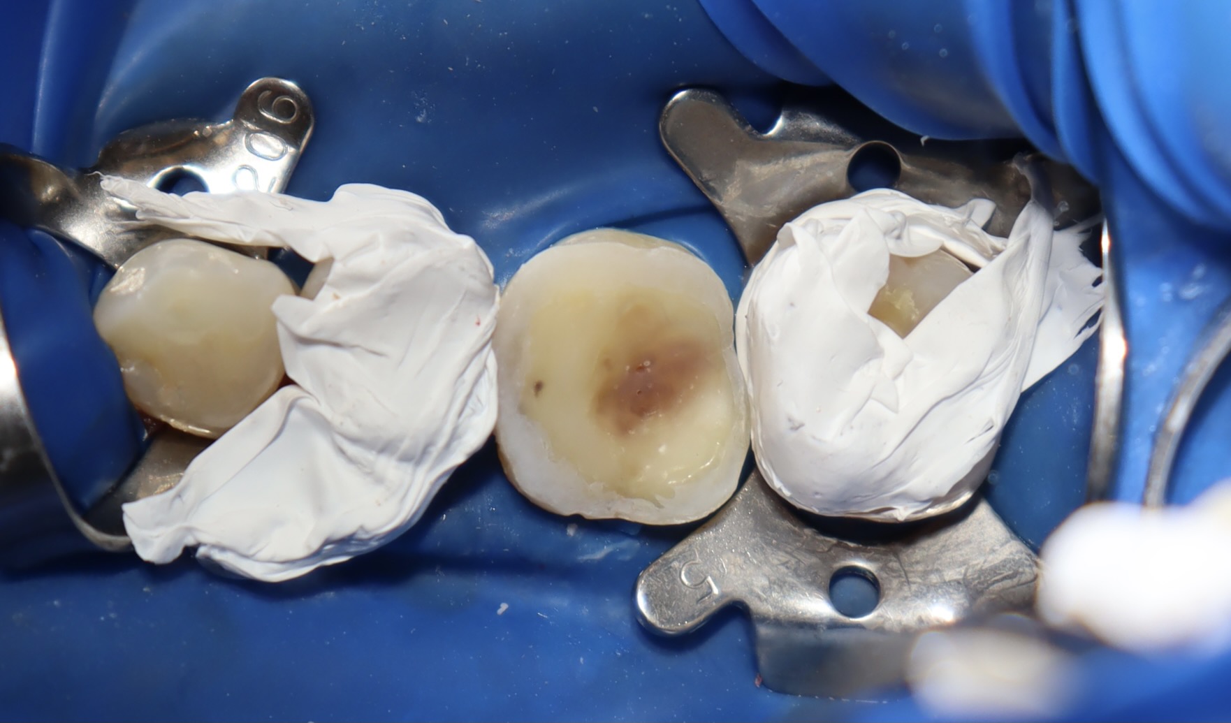 陶瓷嵌體 ft.郭子睿醫師