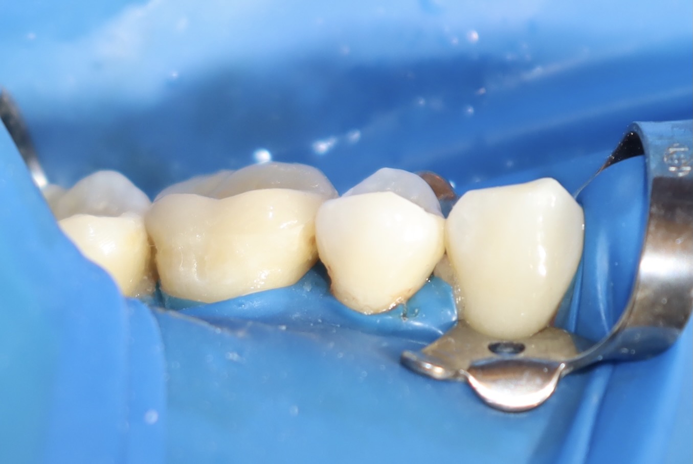 陶瓷嵌體 ft.郭子睿醫師