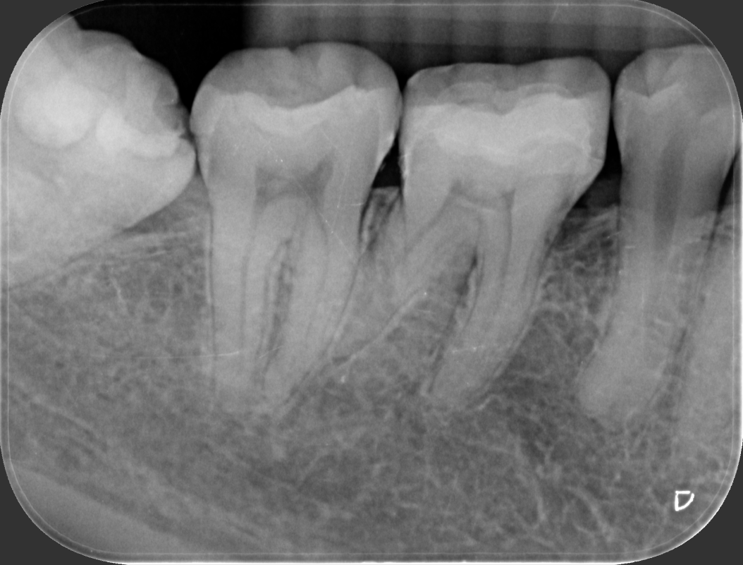 陶瓷嵌體 ft.郭子睿醫師