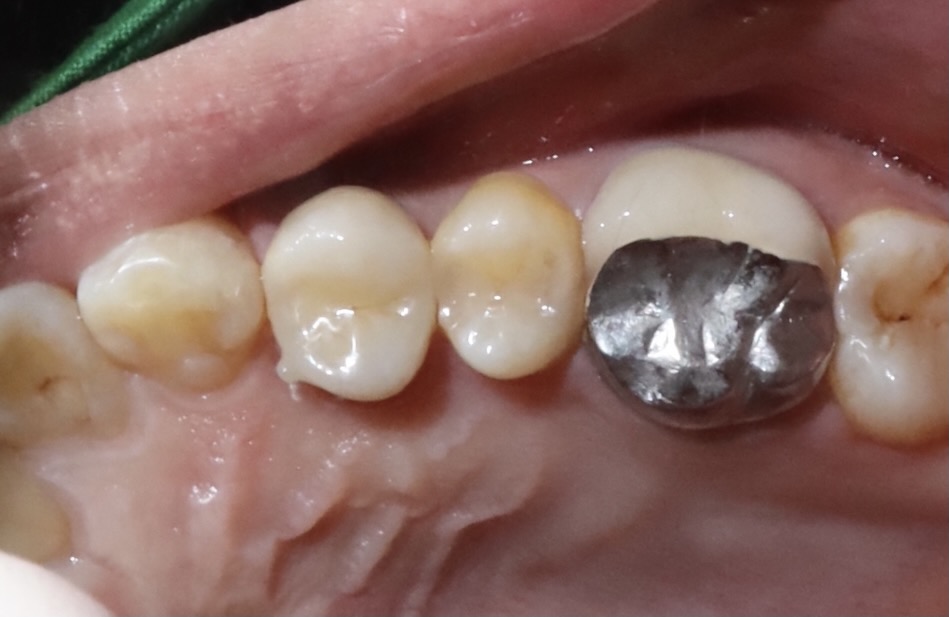 後牙全鋯冠 ft.郭子睿醫師