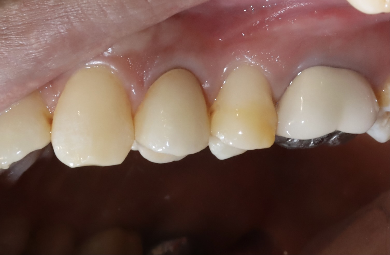 後牙全鋯冠 ft.郭子睿醫師