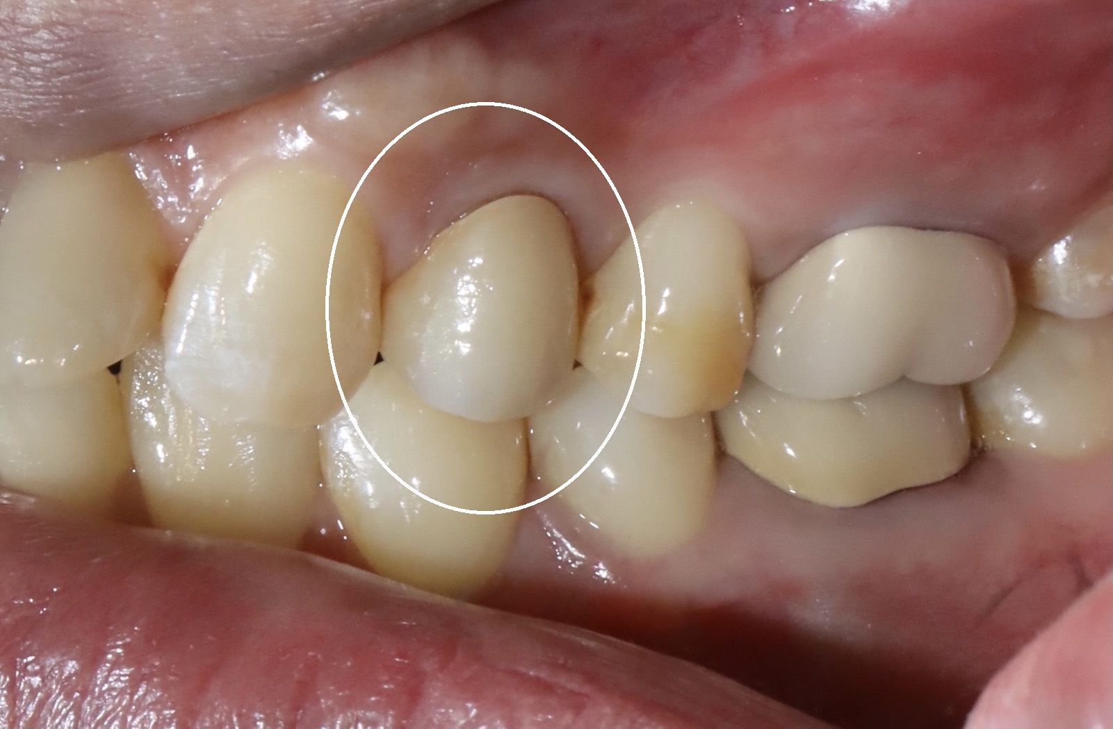 後牙全鋯冠 ft.郭子睿醫師