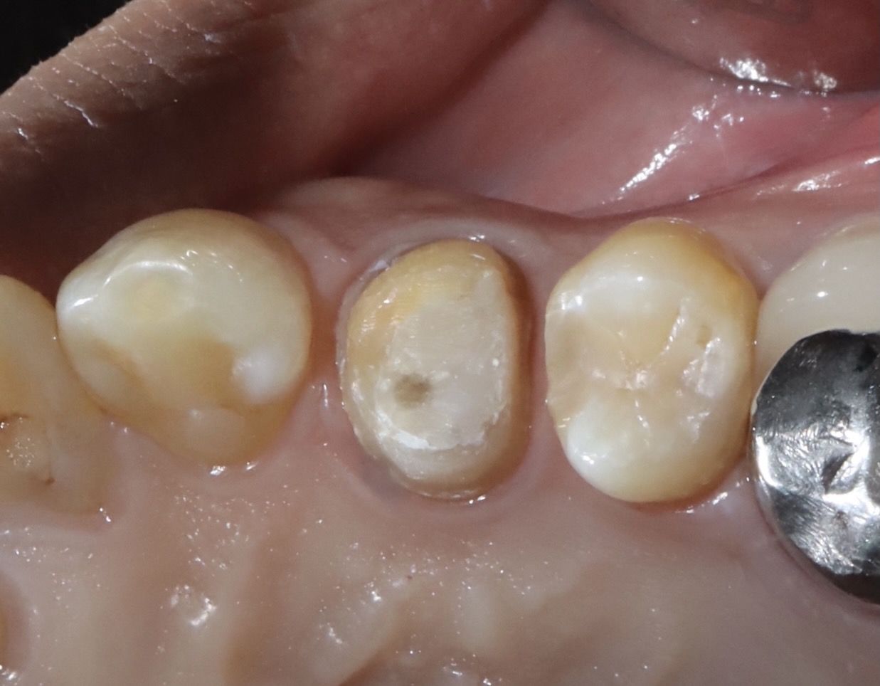 後牙全鋯冠 ft.郭子睿醫師