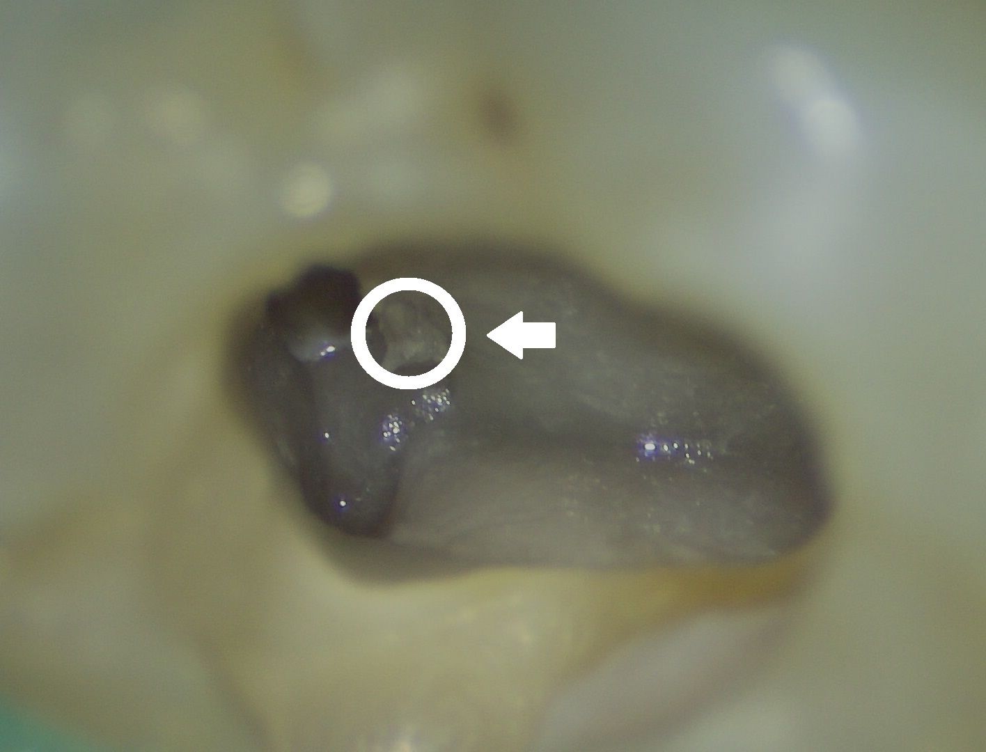 顯微根管案例 FT.郭子睿醫師