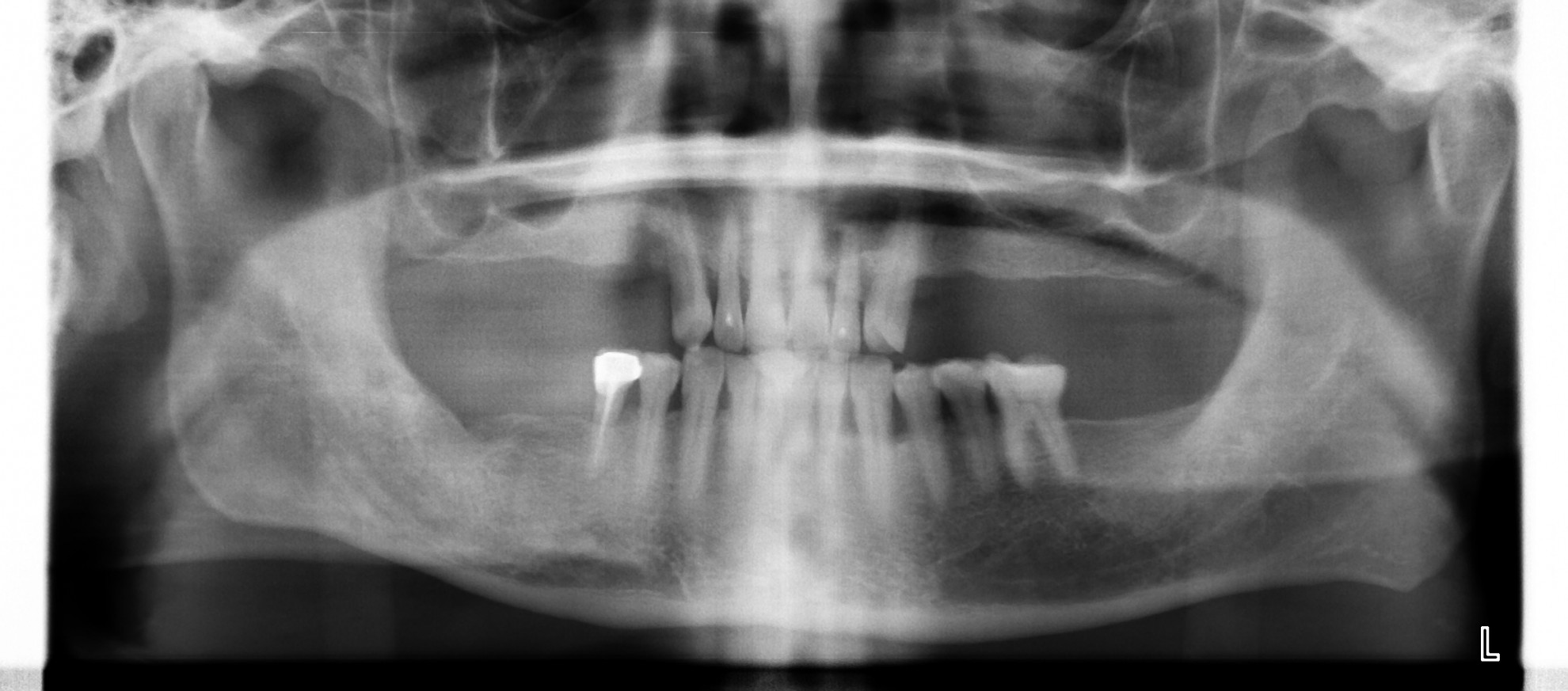 植牙重建合併側窗鼻竇增高 FT.江松岳醫師