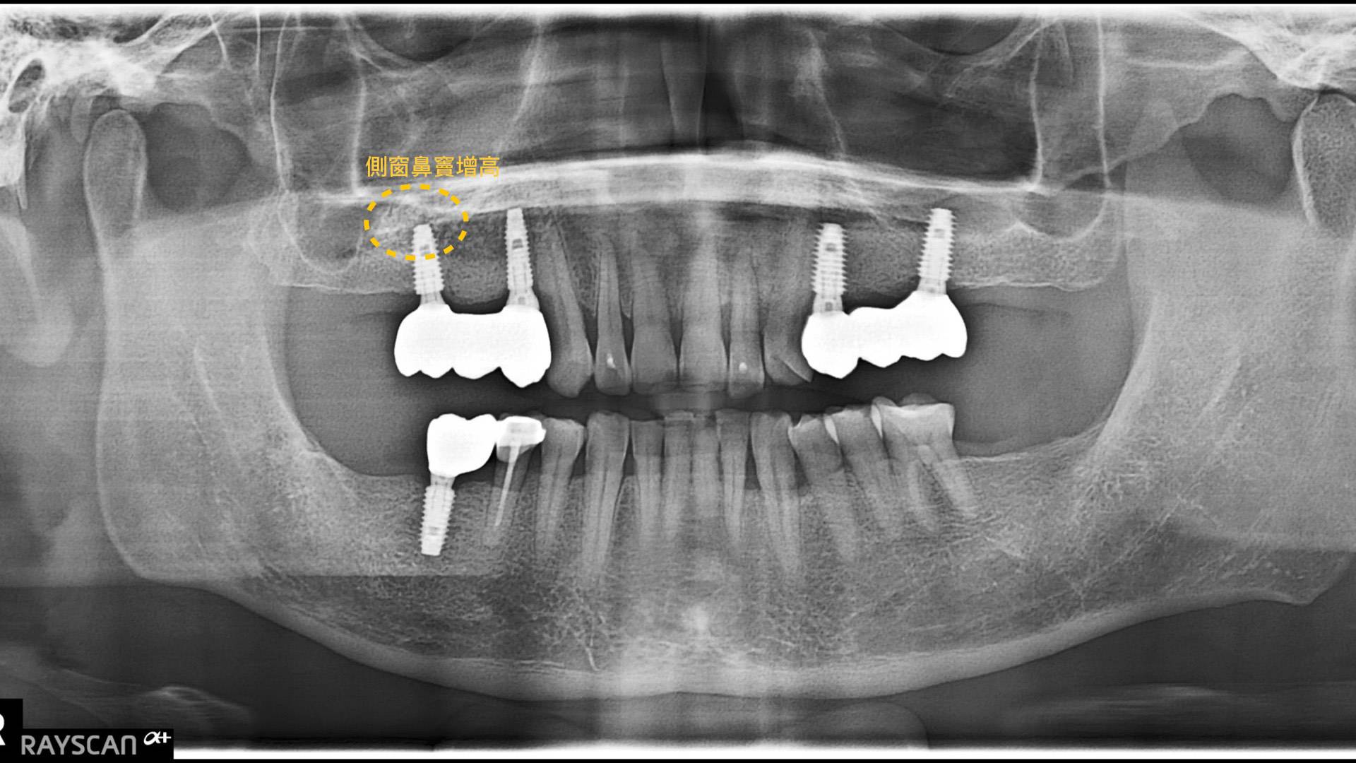 植牙重建合併側窗鼻竇增高 FT.江松岳醫師