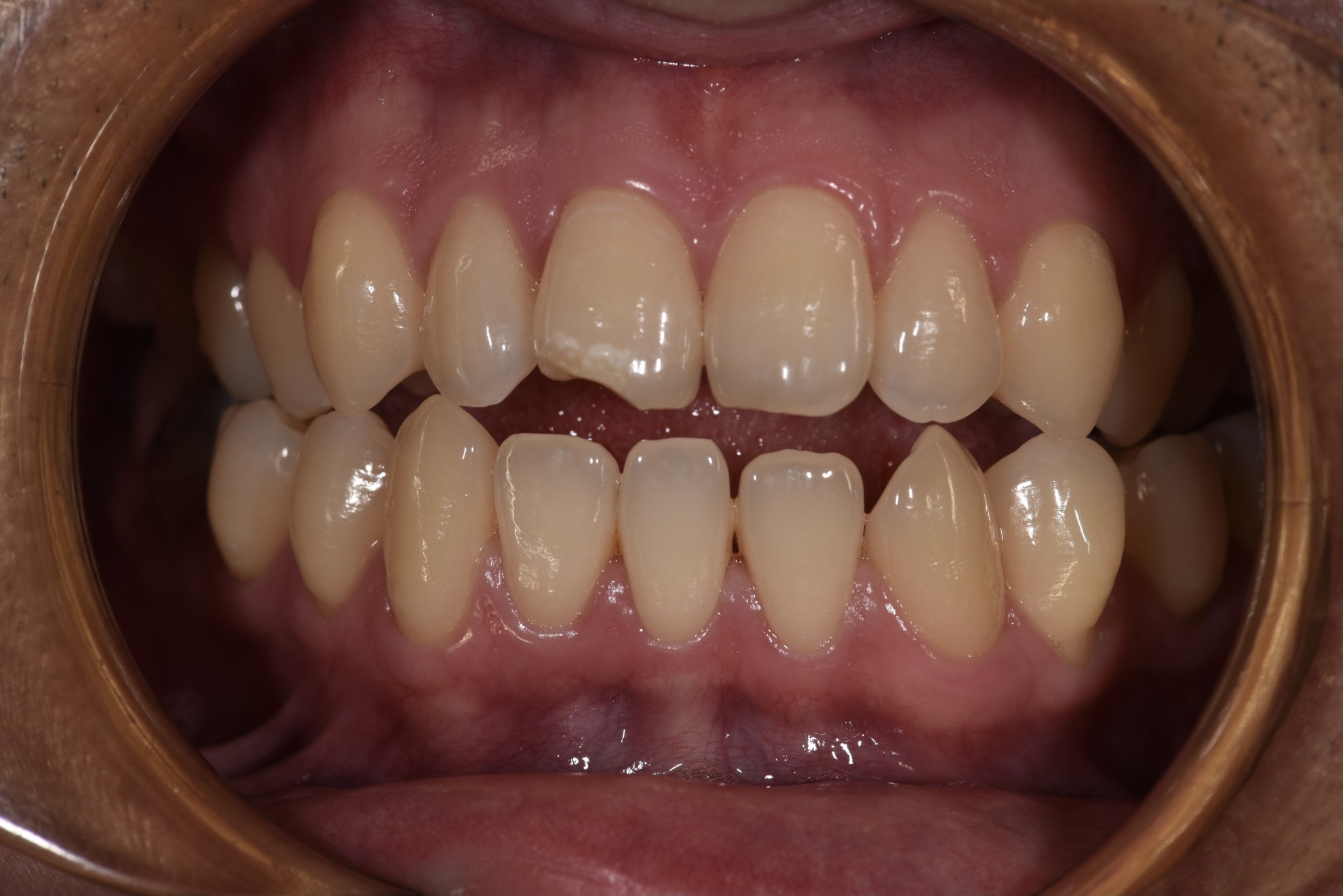 仿真貼片 FT.江松岳醫師