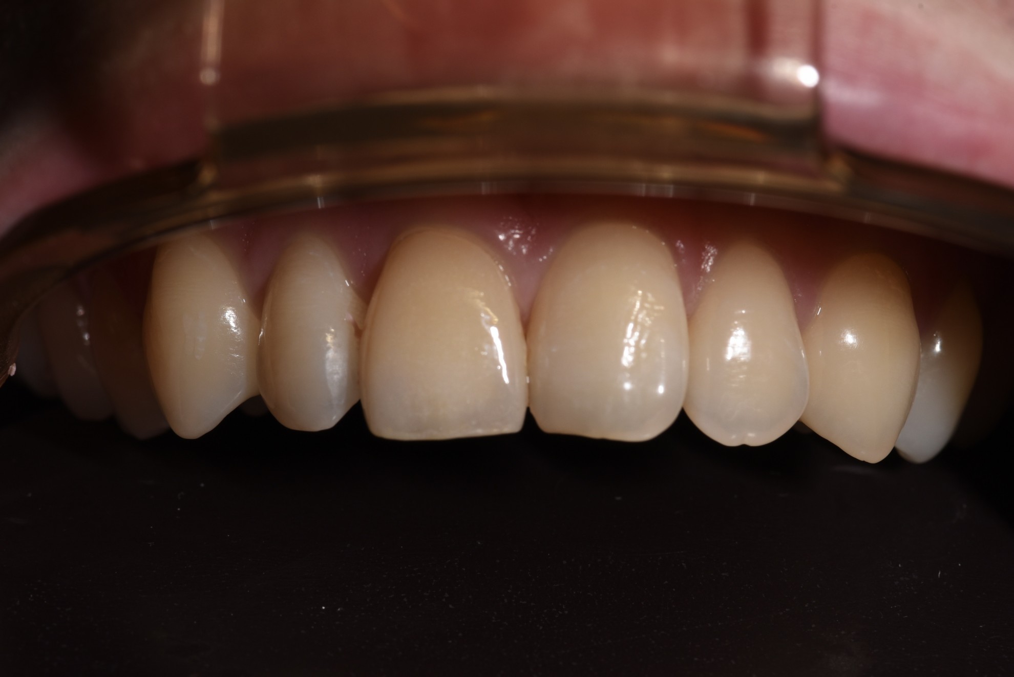 仿真貼片 FT.江松岳醫師