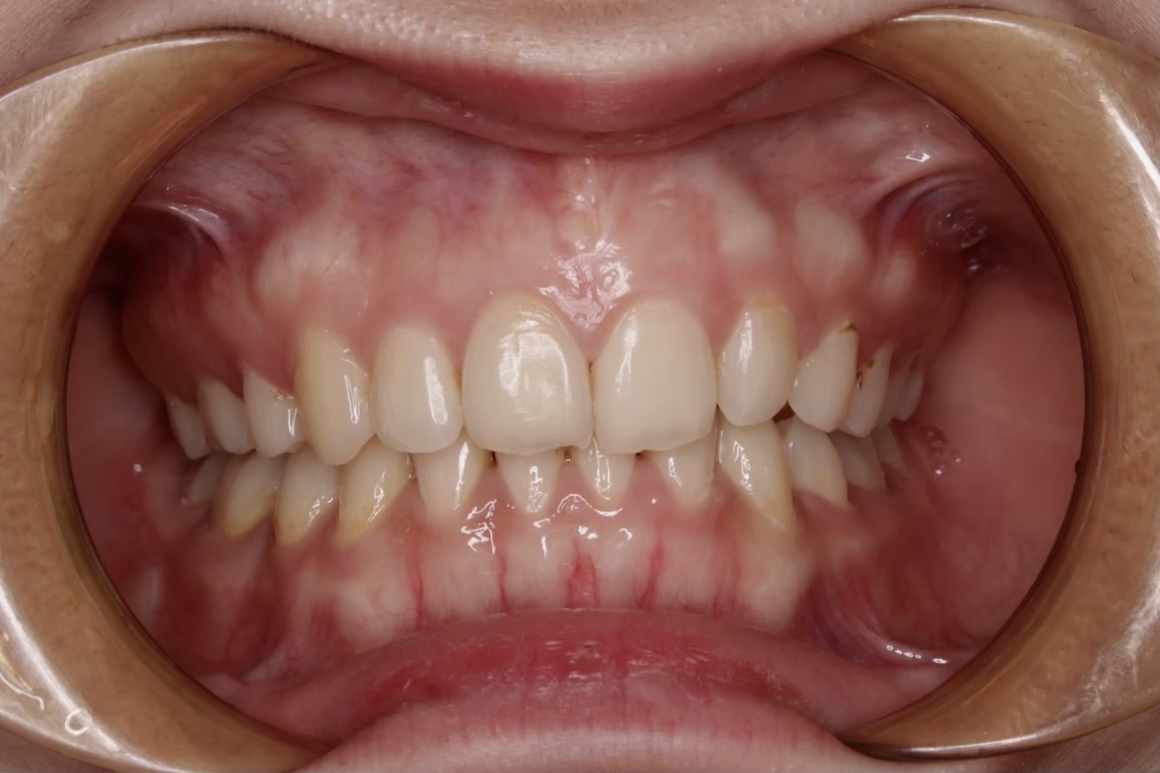 美白貼片 FT.江松岳醫師