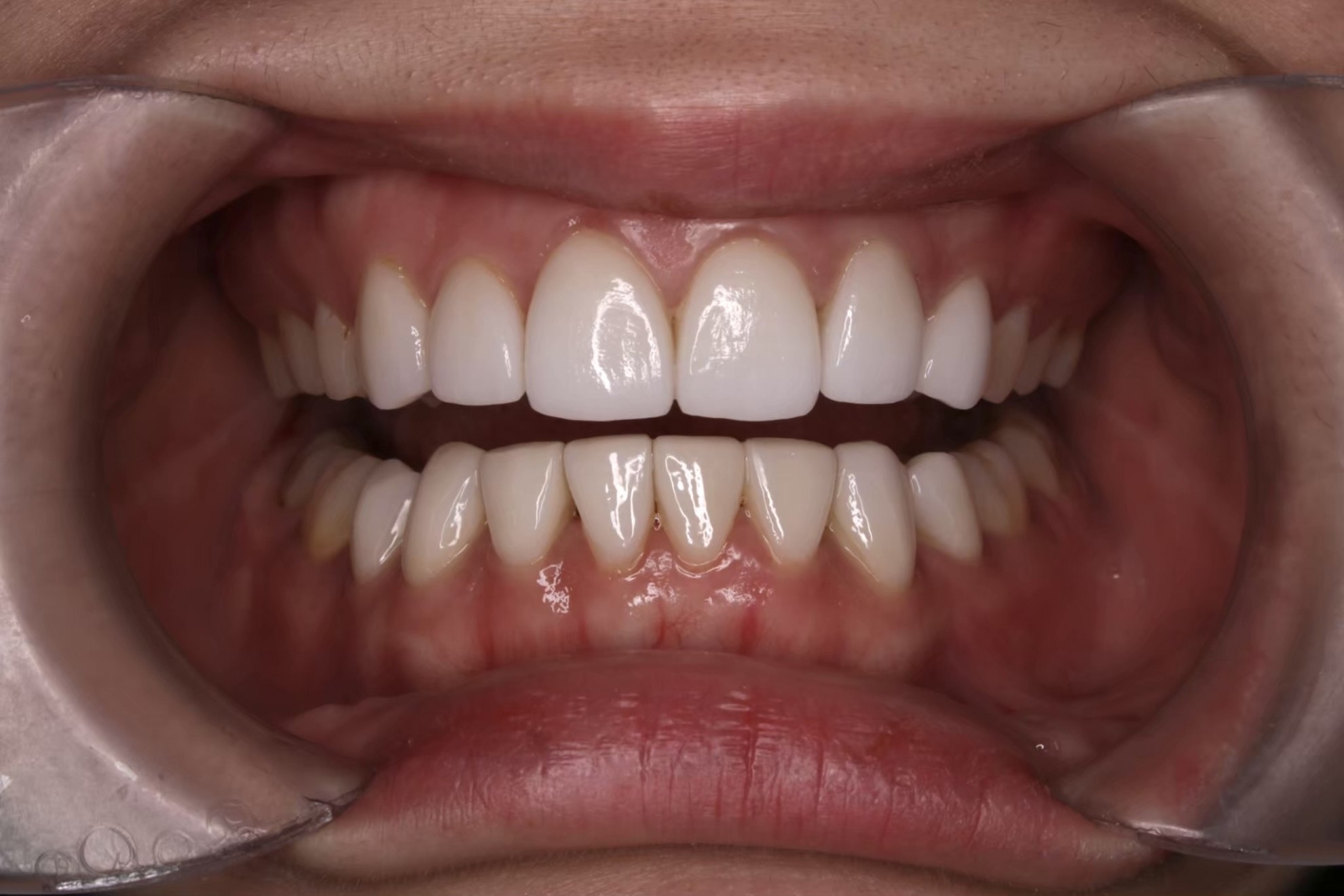 美白貼片 FT.江松岳醫師