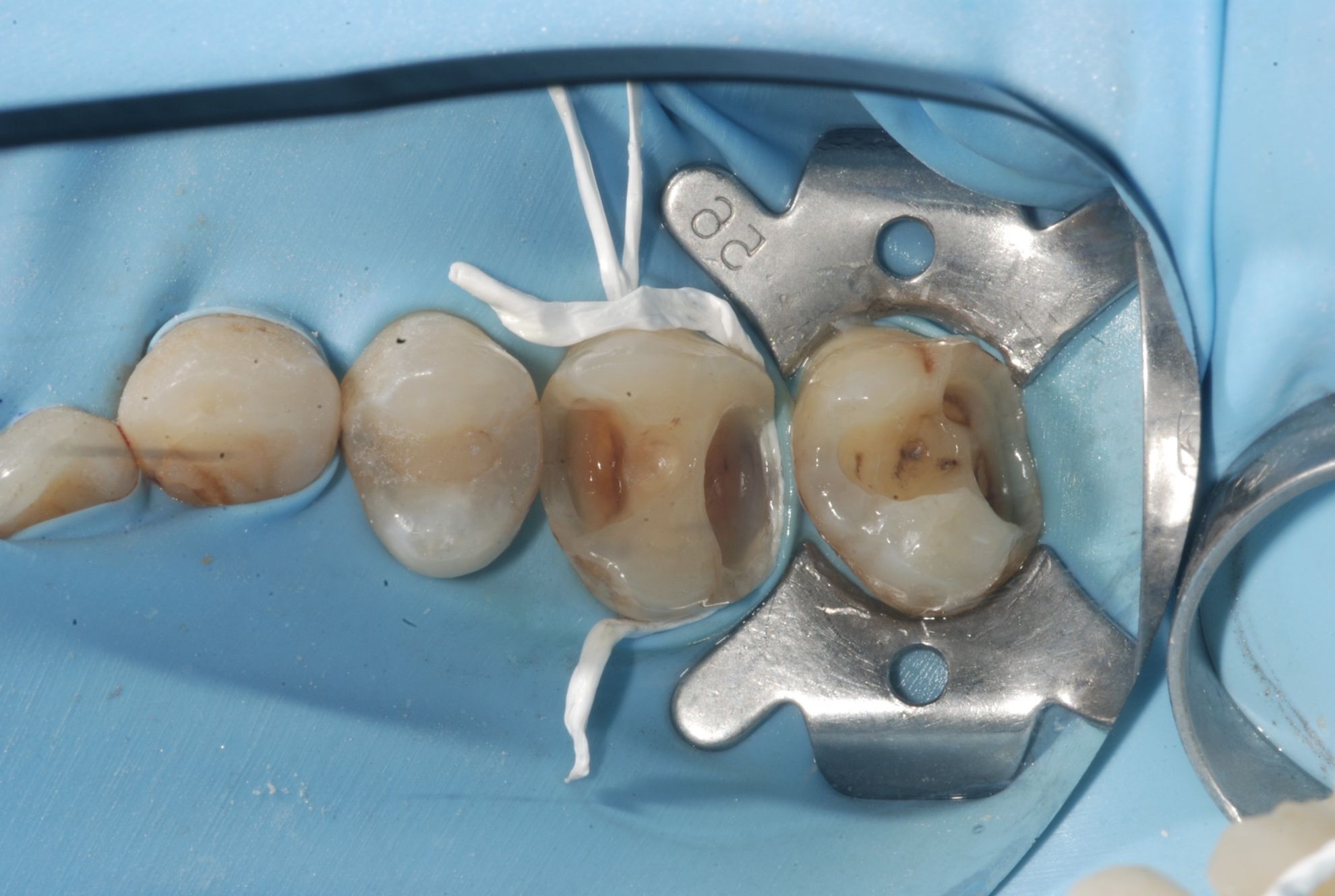 陶瓷嵌體 FT.江松岳醫師