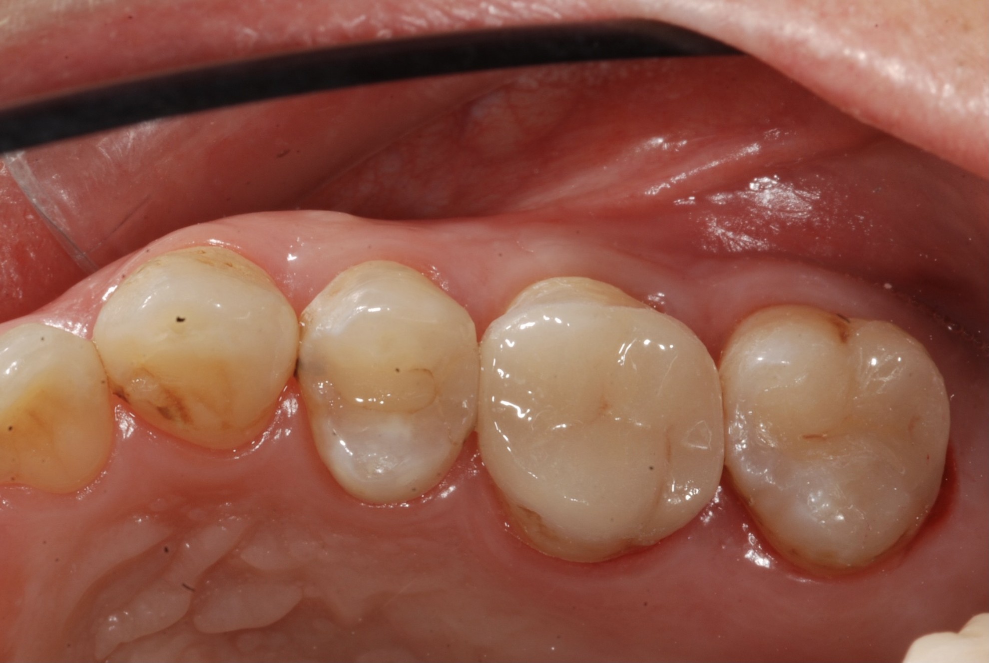 陶瓷嵌體 FT.江松岳醫師