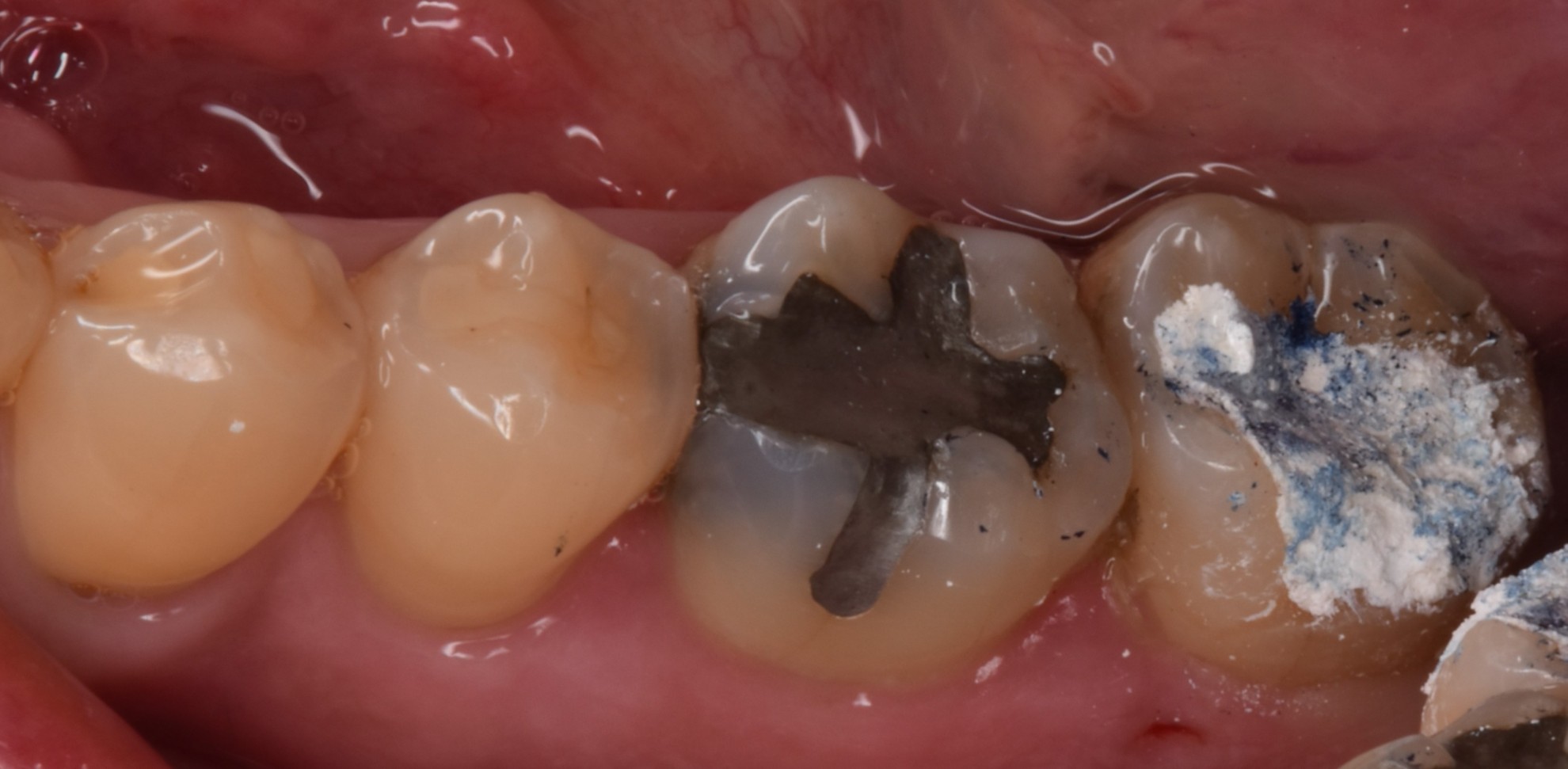 陶瓷嵌體 FT.吳琞淳醫師
