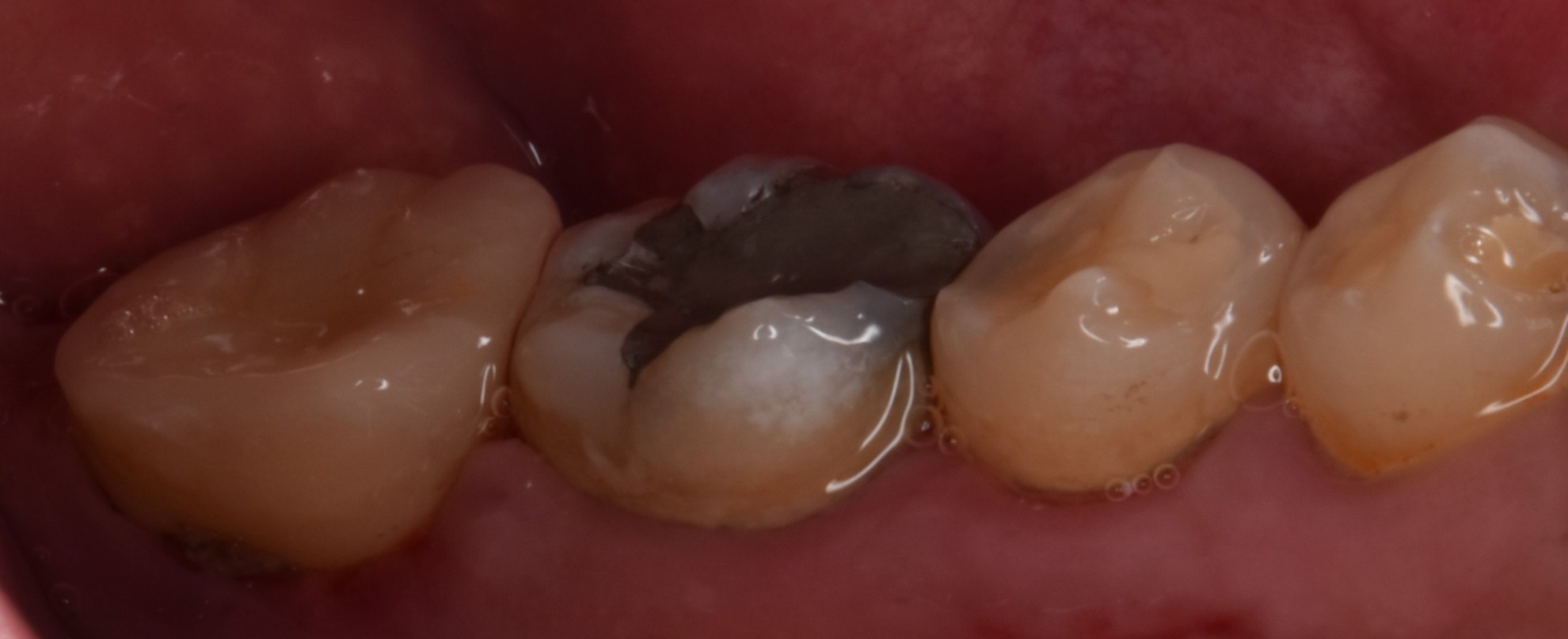 陶瓷嵌體 FT.吳琞淳醫師