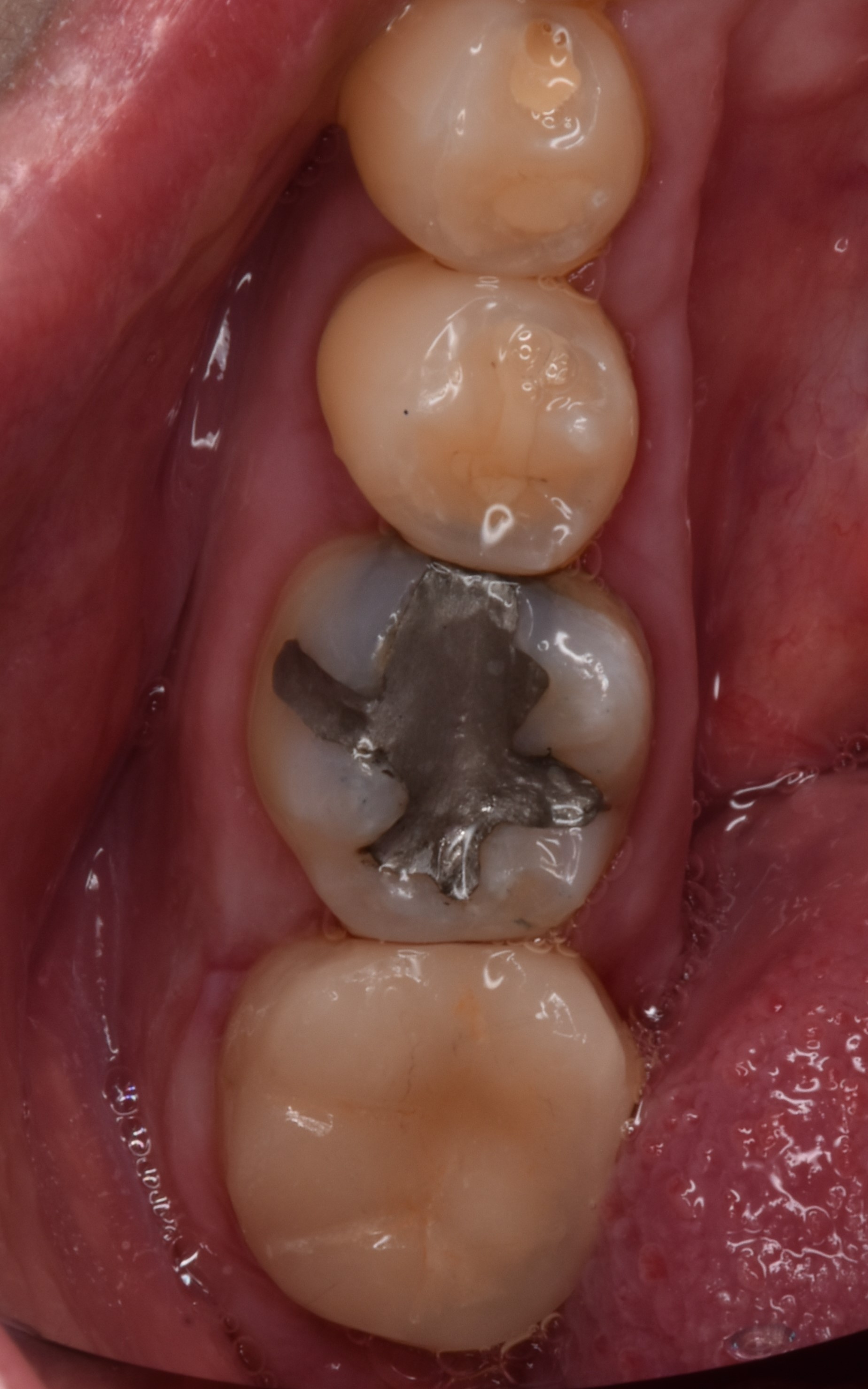 陶瓷嵌體 FT.吳琞淳醫師