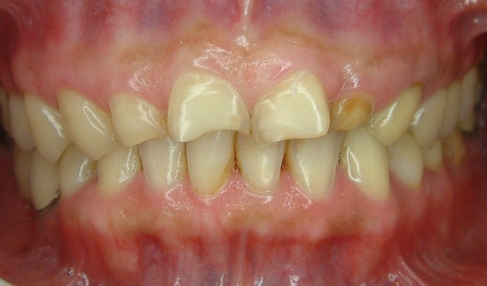 假牙贋復案例 FT.林錫奎醫師