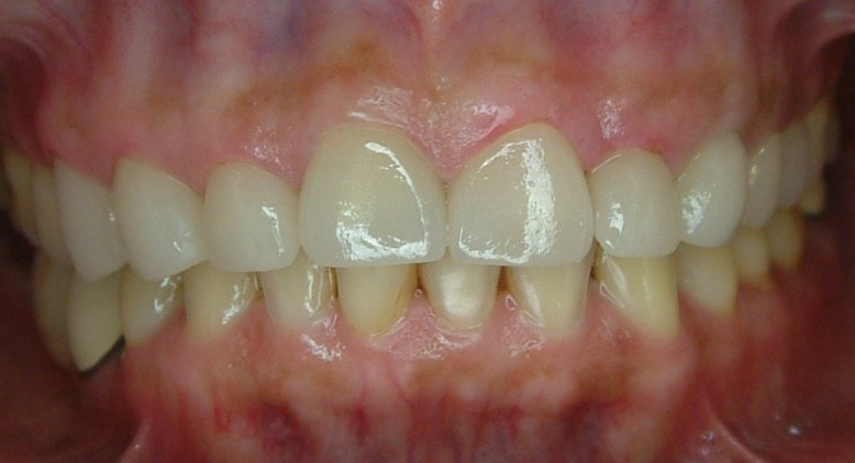 假牙贋復案例 FT.林錫奎醫師