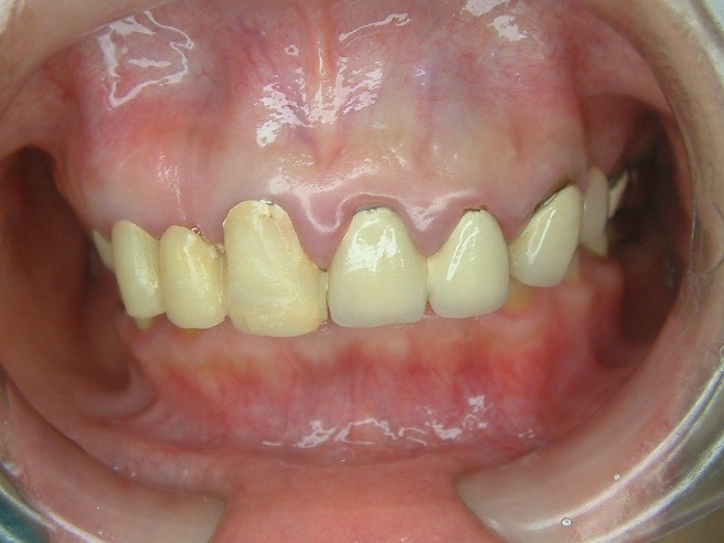 全口重建 FT.林錫奎醫師