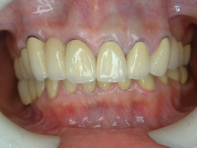 全口重建 FT.林錫奎醫師