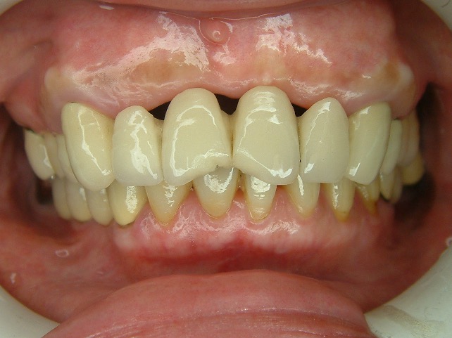 假牙贋復案例 FT.林錫奎醫師