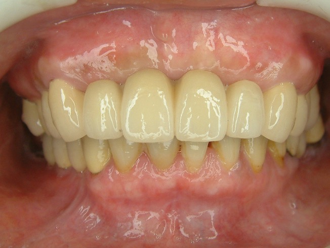 假牙贋復案例 FT.林錫奎醫師