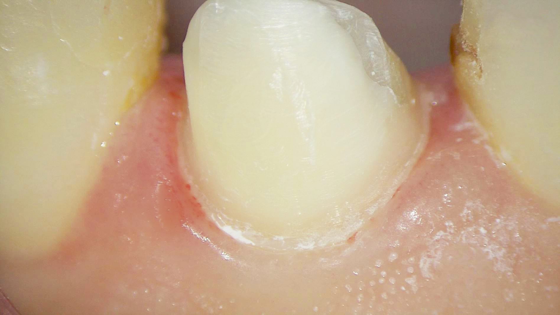 前牙全瓷冠 ft.郭子睿醫師