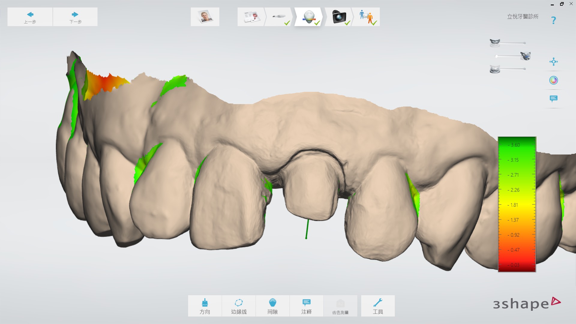 前牙全瓷冠 ft.郭子睿醫師