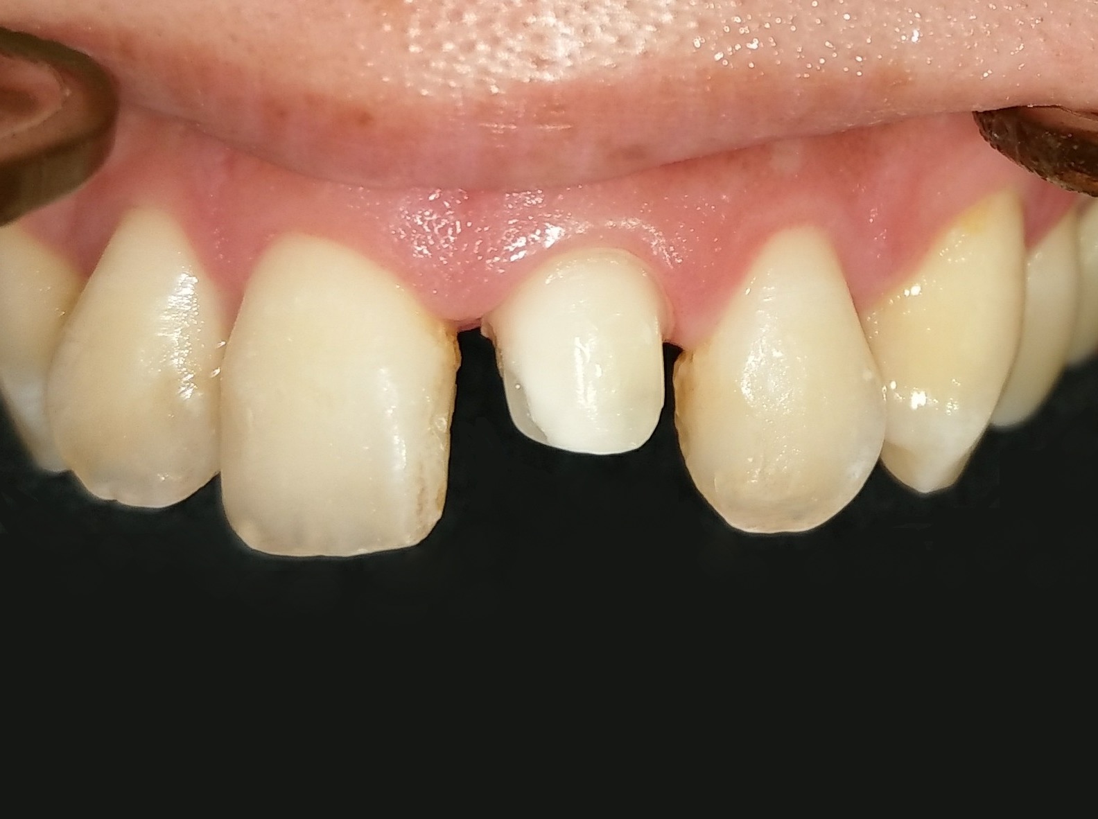 前牙全瓷冠 ft.郭子睿醫師