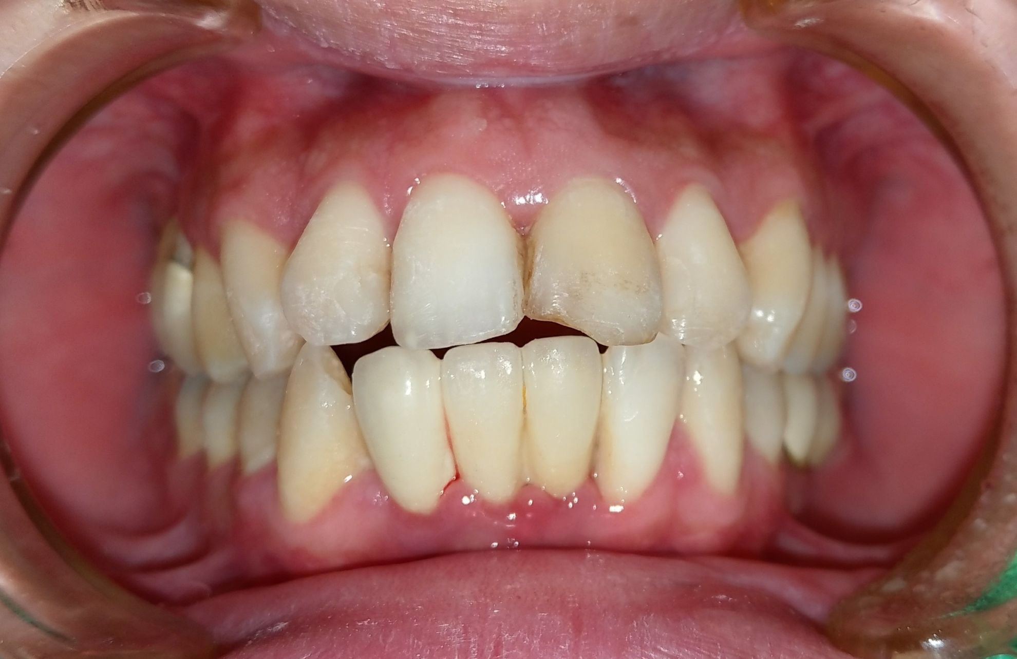 前牙全瓷冠 ft.郭子睿醫師