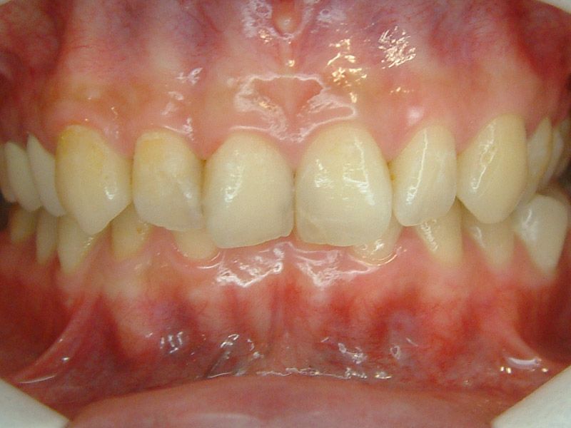 前牙貼片 ft.林錫奎醫師