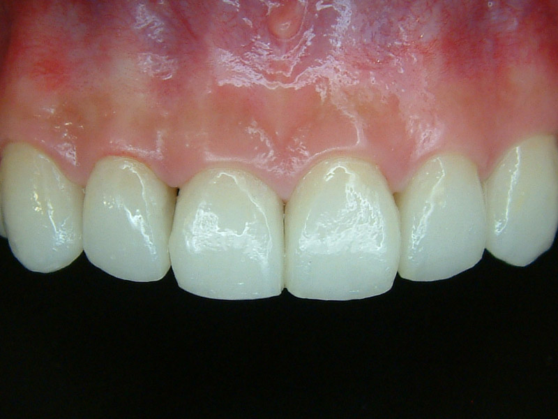 前牙貼片 ft.林錫奎醫師