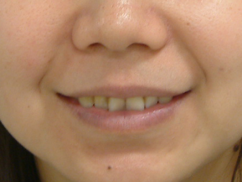 前牙貼片 ft.林錫奎醫師