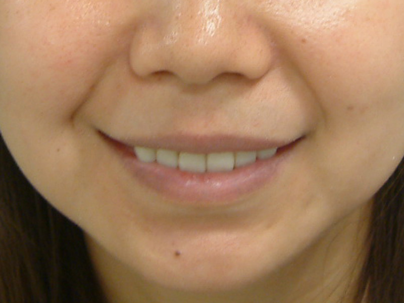 前牙貼片 ft.林錫奎醫師