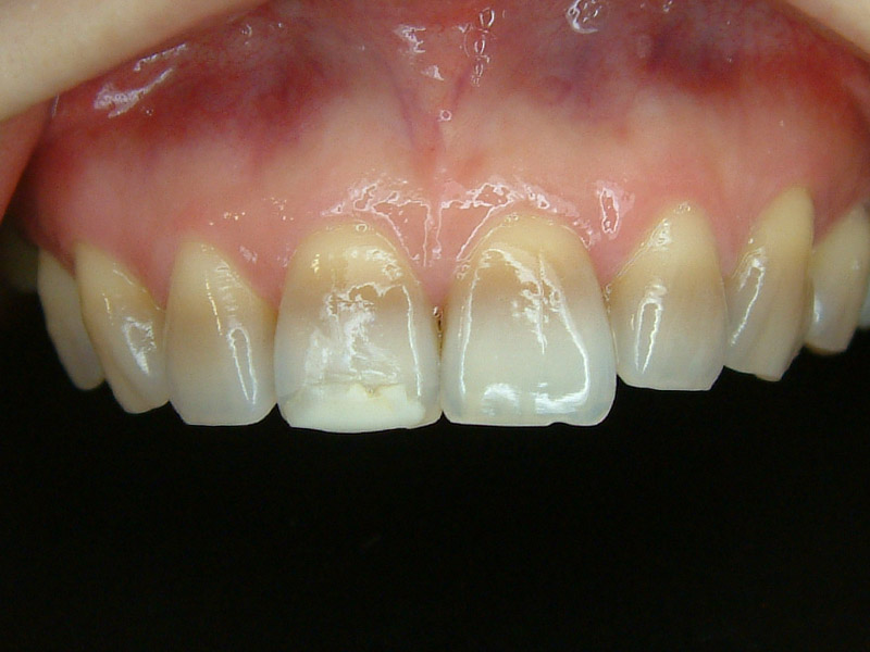 前牙貼片-牙齒變色 ft.林錫奎醫師