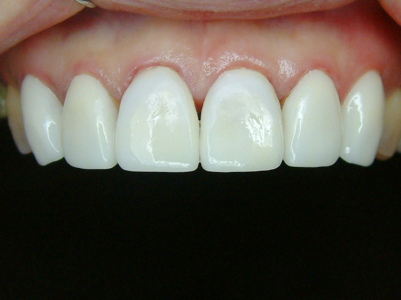 前牙貼片-牙齒變色 ft.林錫奎醫師